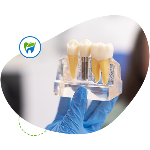 Local Implant Supported